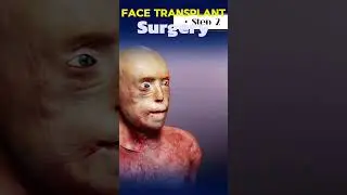 The Miracle of Face Transplant Surgery: Restoring Identity and Function