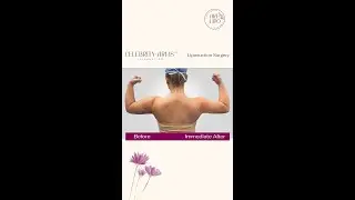 Celebrity Arms™ Liposuction: Achieve a Slimmer Body While Accentuating Your Features