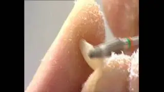 Visio.lign - Veneers Setup