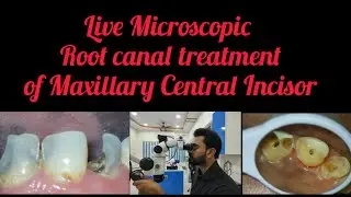 Access opening of Maxillary Central Incisor Step by Step Live Demonstration