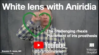 White Cataract Removal in Patient with Aniridia and Placement of Iris Prosthesis