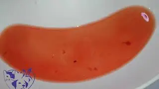 لقطة بعد قثطرة بولية