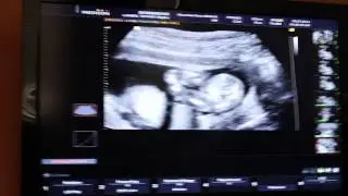 18 Week Ultrasound Gender Reveal