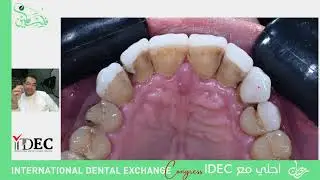 مع النجم المصري     الدكتور عبدالله فاروق وضيف الIDEC لهذه الحلقة   (Veneers gone wrong)