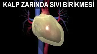 Kalp Zarında Sıvı Birikmesi (Perikardiyal Efüzyon)