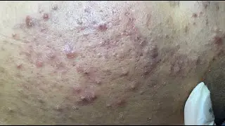 Acne treatment for Hoang (P.1) #HoangMySpa111