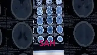 Sub_arachnoid hemorrhage #bleeding #neurology