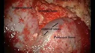 trigeminal schwannoma 01503609 presigmoid