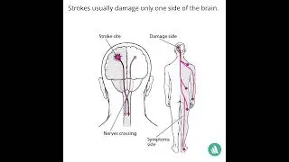 Why Do Strokes Usually Affect Only One Side Of The Body?