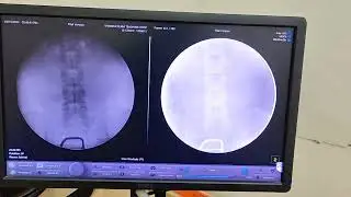 Digitized Fluoroscopy Philips easy Diagnost.