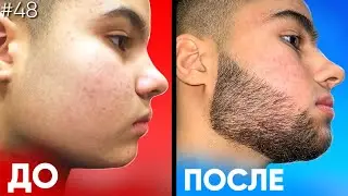 БОРОДА С НУЛЯ ВСЕГО ЗА 5 МЕСЯЦЕВ / Результаты ксиноксина