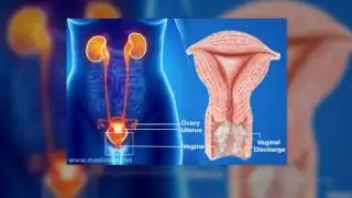 smelly vaginal discharge