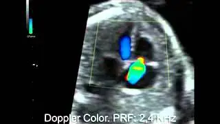 Insuficiencia tricuspidea Doppler Color  Manipulando el PRF