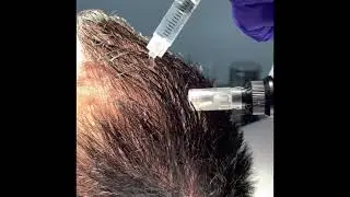 Mesoterapia Capilar y Plasma Rico en Plaquetas. Clínica Merced 👨‍⚕️👩‍⚕️