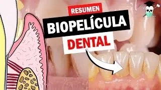 ¿Qué es la PLACA DENTAL, BIOFILM o BIOPELICULA?  *Pirámide de Socransky*