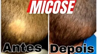 Como curar micose na cabeça tratamento que funciona 99,9% comprovado mata até COVID e bactérias 🦠