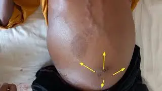 Portal hypertension, Animation | portal hypertension | Liver cirrhosis | direction of blood flow