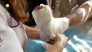 How to treat a diabetic foot with L-Mesitran