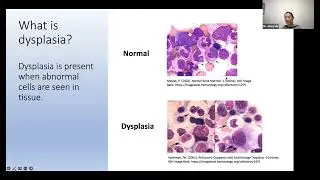 MDS and New Treatment Options - Dr. Jenny Ho