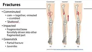 MSK Skeletal System Basics - Fractures