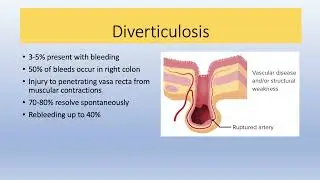 Surgical Management of Complex Lower Gastrointestinal GI Bleeding