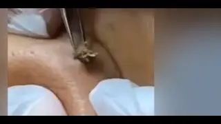 **HUGE** Blackheads, Clogged Pores, and Pimple Extraction Compilation