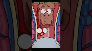 Surgical resection process