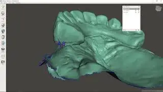 Fabricating a Difficult Immediate Denture from Intraoral Scans
