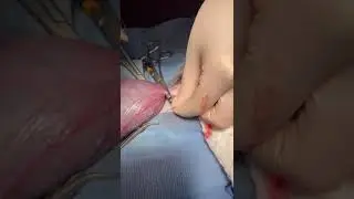 modified Miller's tie on a pregnant cat uterus