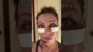 Step-by-Step Deep Plane Face Lift | Dr Julian De Silva