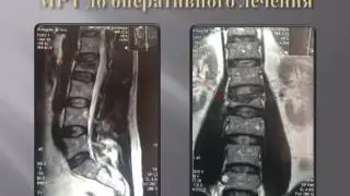 Вертебропластика при переломах и симптоматических гемангиомах грудо-поясничного отдела позвоночника