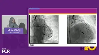 Cardiogenic shock and high-risk interventions with percutaneous mechanical circulatory support