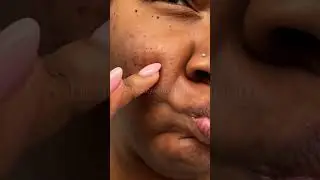 Pimple Patch Chronicles | Bajan m*n and the fyp 🤪🫡 #pimplepatch #omg