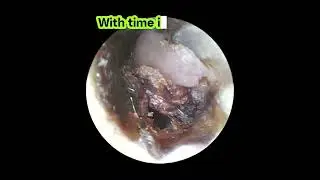 Ear Wax:  a brief history 😆. #earwax #earwaxremoval #entdoctor #cerumen_removal