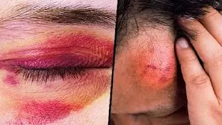 How to Get Rid of Bruises: 5 Effective Home Remedies.