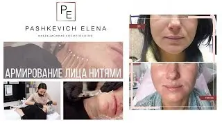 Армирование лица. Подтяжка мезонитями. Худое лицо. Фото до/после