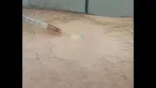 Удаление липомы