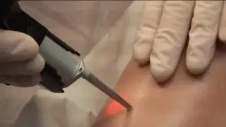 Epilation Laser A Paris - L'épilation laser est-elle définitive?