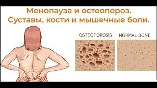 Менопауза и остеопороз. Боли в мышцах и суставах.