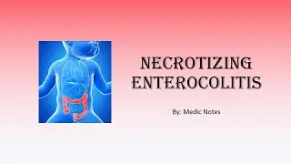Necrotizing enterocolitis - definition, clinical features, investigations, management