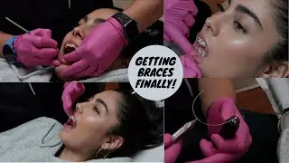 GETTING MY WIRES PUT ON!! (BRACES PT. 3)