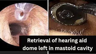 Video showcasing the removal of a hearing aid dome from the mastoid cavity.