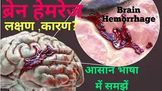 Brain Hemorrhage || ब्रेन हेमरेज क्या होता है? #लक्षण ,कारण🤔