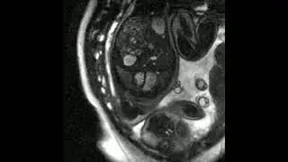 Fetal Heart Disease Visible for First Time on Real-Time MRI Scan for Expectant Mothers