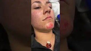 Revitalize Your Skin: The Power of Microneedling #Microneedling