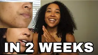 HOW TO GET RID OF ACNE IN 2 WEEKS| Vitamins that 100% work