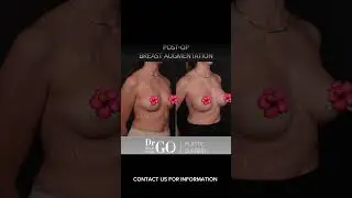 Before and After Rhinoplasty - Dr Guncel Ozturk 