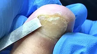 Hard nail fungus! Complete and detailed treatment【TD Foot care】
