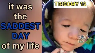 Trisomy 13: The day my son stopped smiling