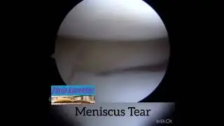 Normal Meniscus Vs Meniscal Tear
